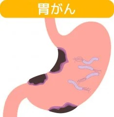 胃粘膜不整は胃癌のサインであることも